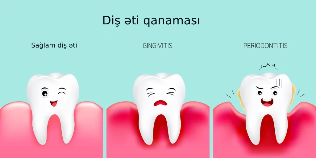 diş əti qanaması