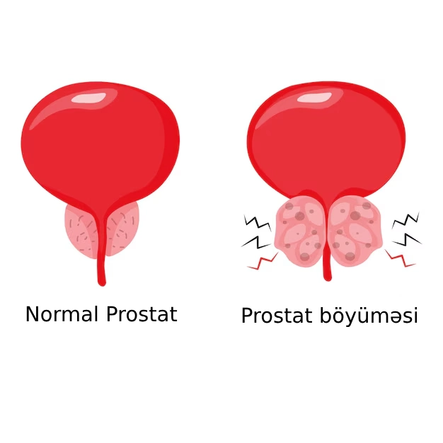 kişilərdə prostat böyüməsi