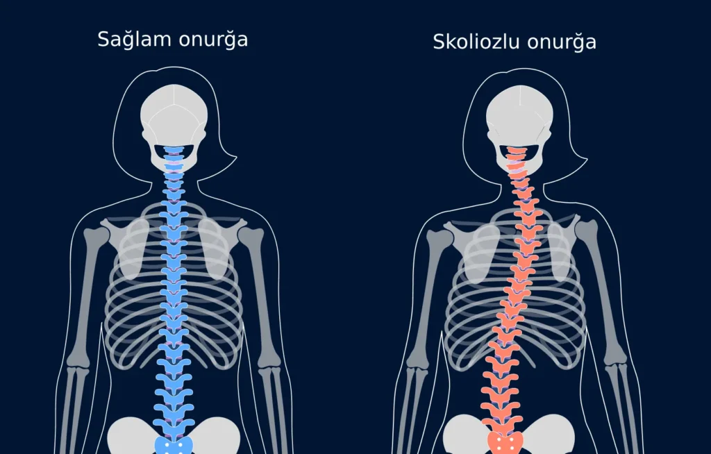 skoliozun müalicəsi